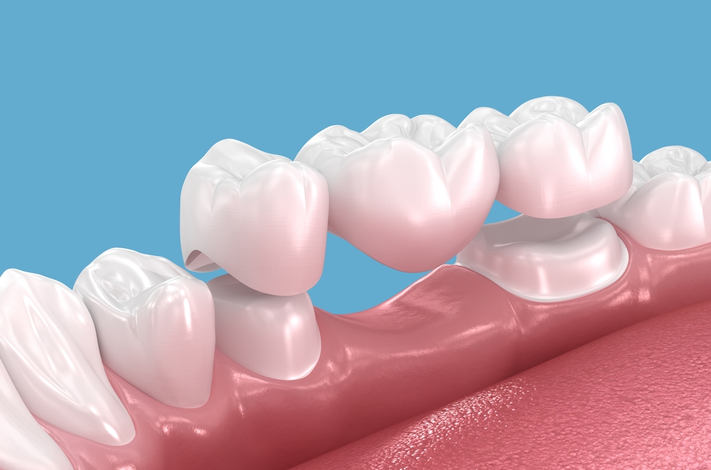 Dental Bridges Cedar Hill