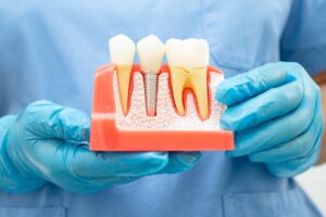 Dental Implants Cedar Hill
